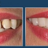 Cosmetic Dentistry – Changing Smiles